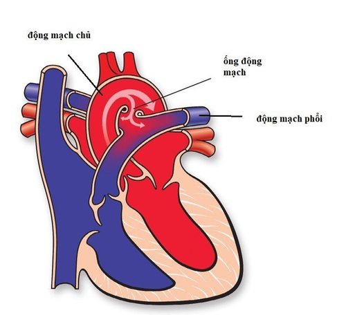 Điều trị ống động mạch hình phễu chưa tăng áp phổi ở trẻ như thế nào?