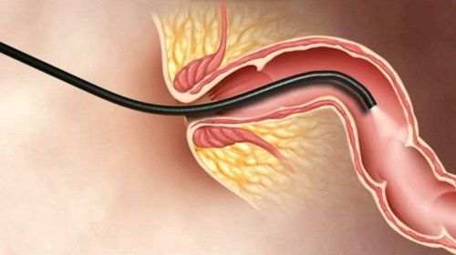 Total colonoscopy with flexible tube