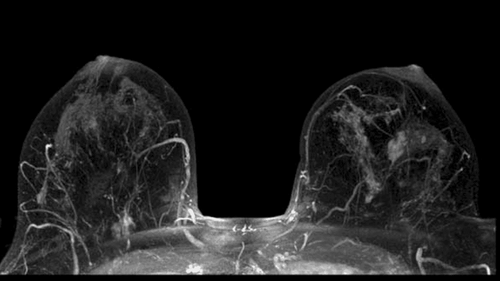 Preparing for a Breast MRI