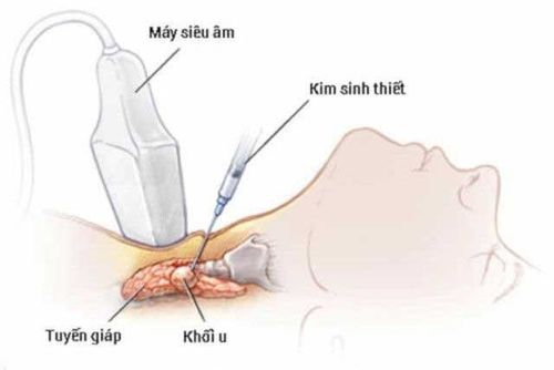 
Sinh thiết kim và chọc hút dịch dưới sự hỗ trợ của siêu âm
