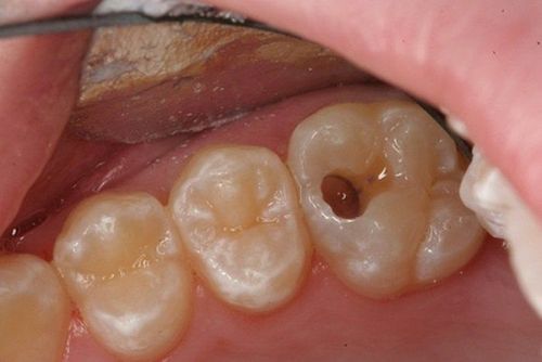 Trẻ bị sâu răng hàm sát nướu có cần nhổ không?