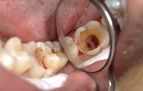 Cách điều trị cho trẻ 2 tuổi bị thủng lỗ trên mặt nhai của răng hàm