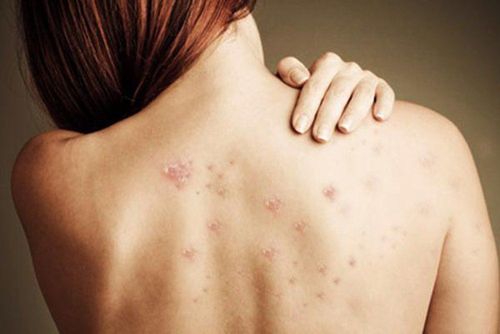 Back acne: Causes and solutions