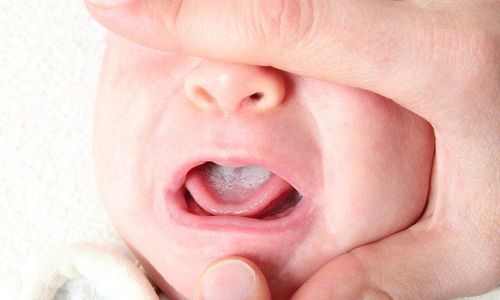 Trẻ sơ sinh bị chảy máu nhiều khi rơ lưỡi