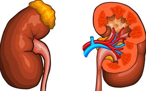 What is renal cell carcinoma? Causes and symptoms