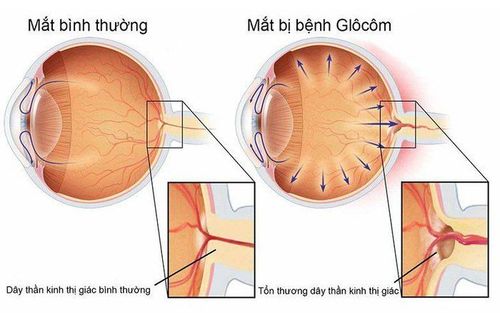 
Bệnh Glocom ở mắt là bệnh lý nhãn khoa làm tăng nhãn áp quá giới hạn bình thường
