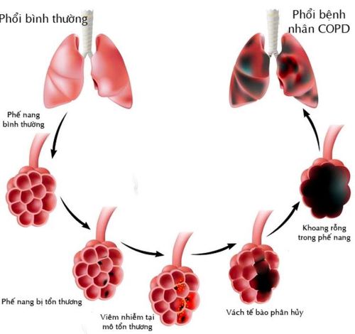 
Bệnh phổi tắc nghẽn mạn tính COPD
