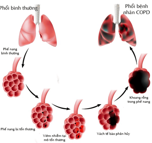 
COPD tiến triển
