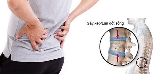 Các triệu chứng của gãy xương cột sống