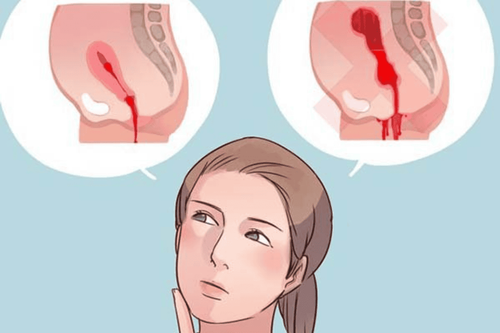 Cervical dilation due to fluid retention