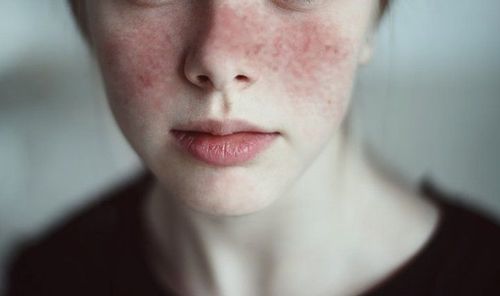 
Bệnh lupus ban đỏ hệ thống
