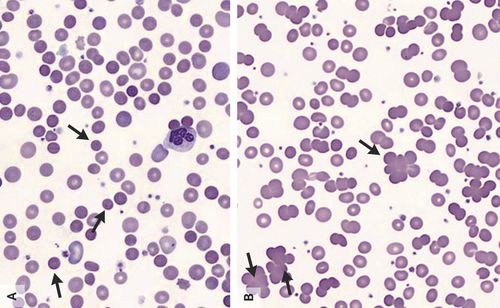 Clinical and laboratory diagnosis of autoimmune hemolytic disease