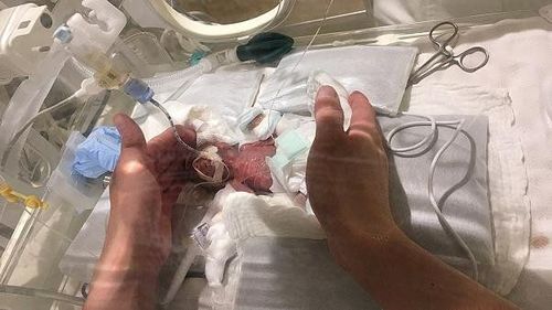 
Premature babies born before 28 weeks
