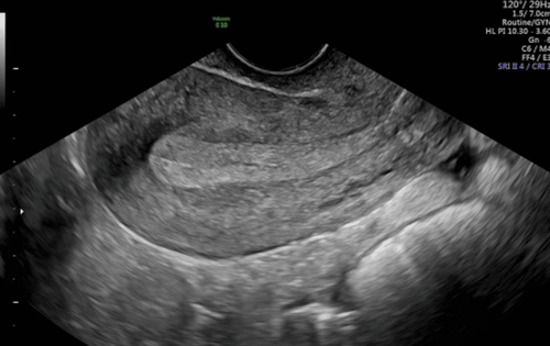 What does 48mm DAP uterine ultrasound and 4mm clear endometriosis mean?