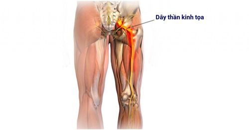 Diagnosis and treatment of sciatica