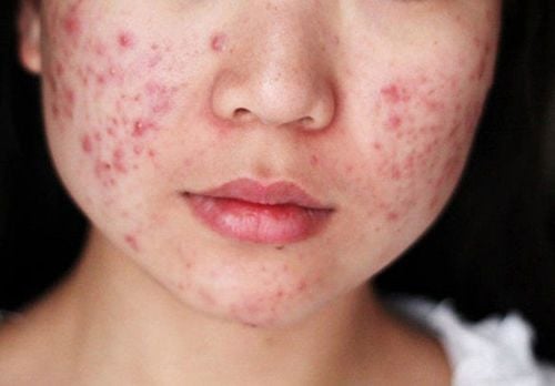 What foods are good for acne skin?