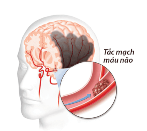 Tắc mạch máu não can thiệp, điều trị thế nào?