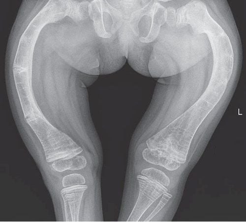 Learn about the disease of osteogenesis imperfecta in children (glass bone)