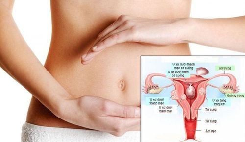 Đau vùng chậu kèm đau quặn bụng dưới ở bệnh nhân u xơ tử cung có sao không?