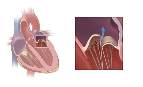 Diagnosis and treatment of mitral valve prolapse