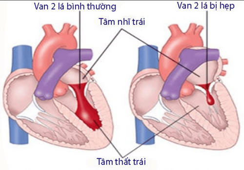 Ho ra máu trong hẹp van 2 lá và những điều cần biết