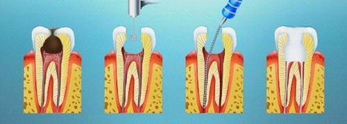 
Quy trình diệt tủy răng
