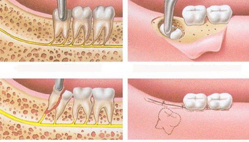 Sau nhổ răng số 8 có cần khâu lại huyệt nhổ răng?