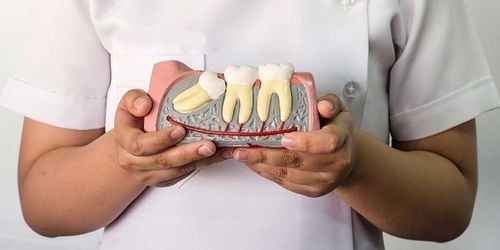 Tình trạng răng khôn bị sâu ăn vào tủy ở trẻ nhỏ có nguy hiểm không?