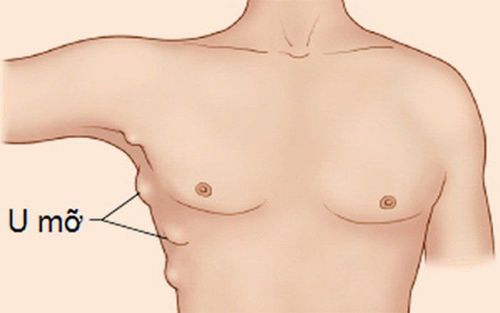 Lipoma: When to have surgery?