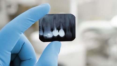 X-ray of apical teeth: When to perform?