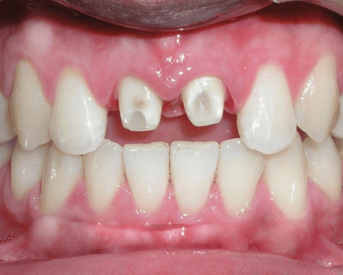 Should you grind your teeth to make porcelain teeth?