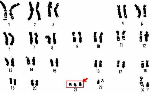 
Bất thường 3 nhiễm sắc thể 21
