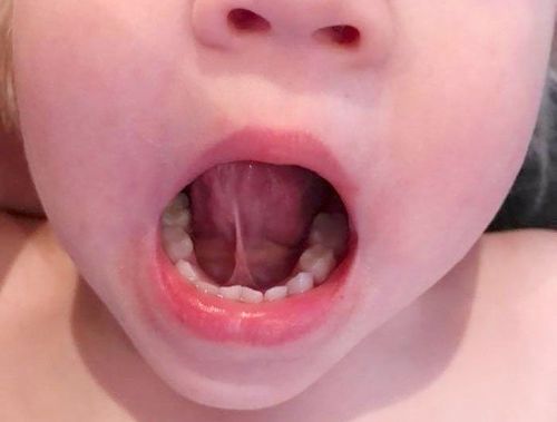 Trẻ 2 tuổi chưa nói được nhiều có nên phẫu thuật cắt thắng lưỡi?