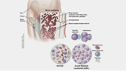 Acute myeloid leukemia