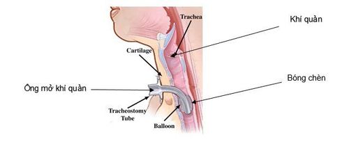 Percutaneous tracheostomy emergency suffocation