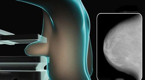 The role of mammograms in the diagnosis of breast disease and breast cancer