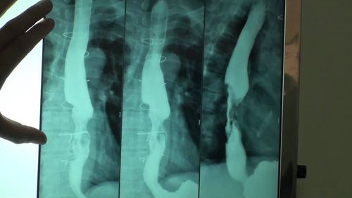 Imaging and node of the inferior portal vein system Enlarged X-ray