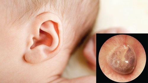 Treatment of acute otitis media with pus stasis