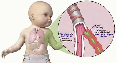 
Tình trạng viêm tiểu phế quản cấp
