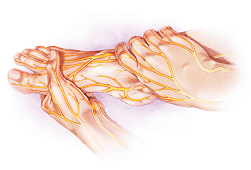 Peripheral neuroma surgery