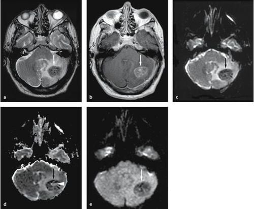 
Chụp cộng hưởng từ khuếch tán (DWI-Diffusion-weighted Imaging)
