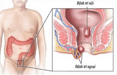 
Vị trí trĩ ngoại
