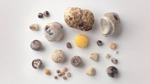 Sỏi niệu quản có nhiều kích thước khác nhau