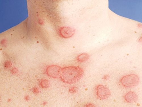 
Viêm não tự miễn có liên quan đến một số bệnh tự miễn như Lupus ban đỏ
