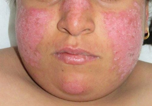 
Bệnh nhân nữ mắc lupus ban đỏ dạng đĩa
