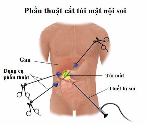 Những điều cần biết về bệnh lý viêm túi mật cấp do sỏi túi mật