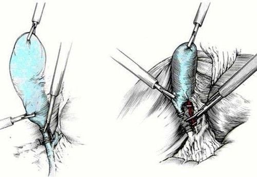 
Cắt túi mật là một phẫu thuật phổ biến và chỉ để lại nguy cơ biến chứng nhỏ.
