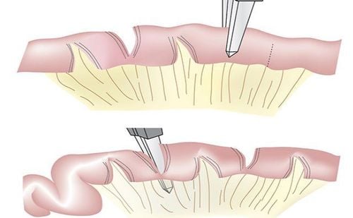 
Hội chứng ruột ngắn (Short Bowel Syndrome)
