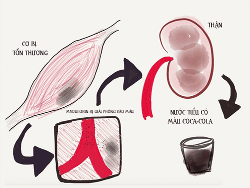 
Cơ vân bị tiêu làm thay đổi màu nước tiểu
