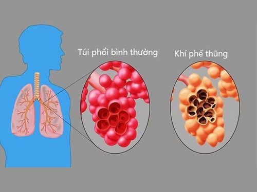 
Khí thũng phổi bẩm sinh
